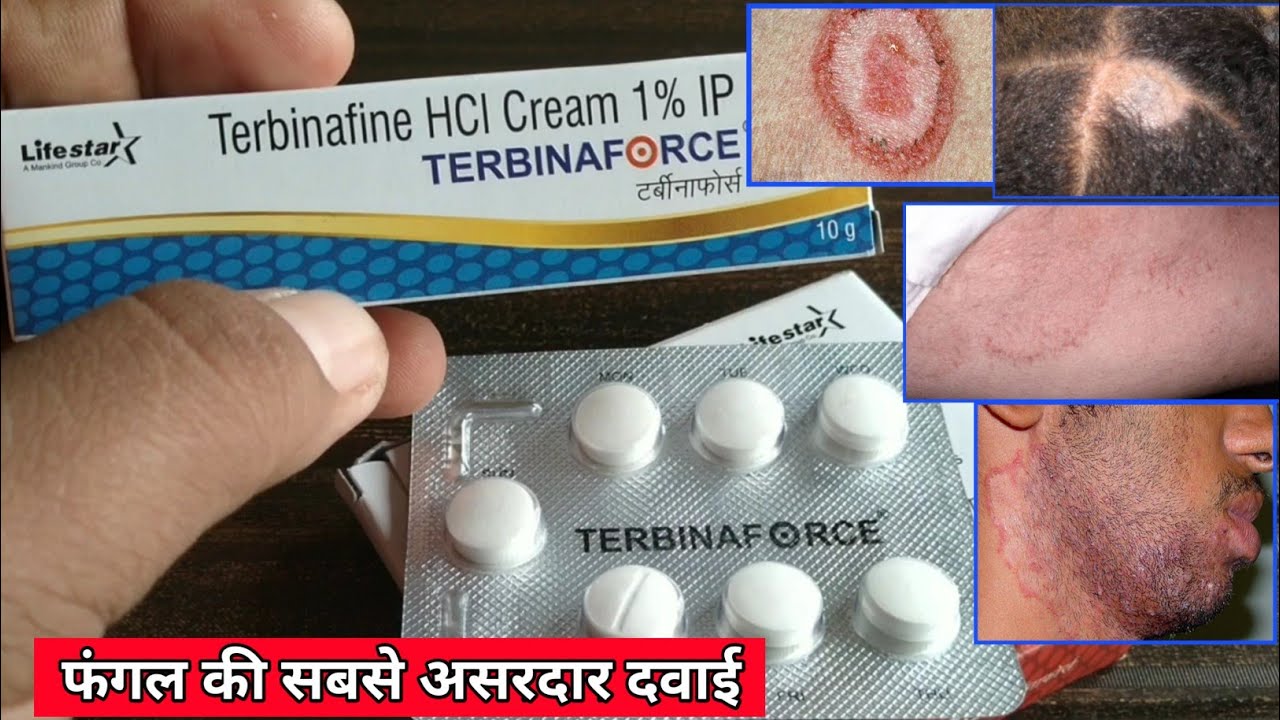 Terbinafine in hindi